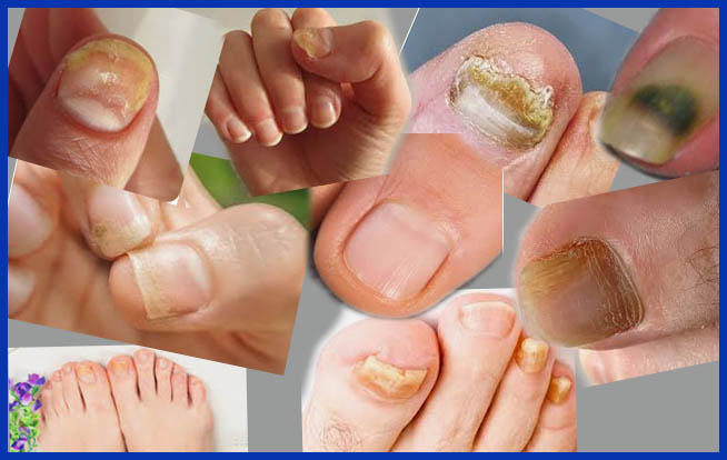 Examples of discolored, crumbling, brittle and thickened nails affected by fungus